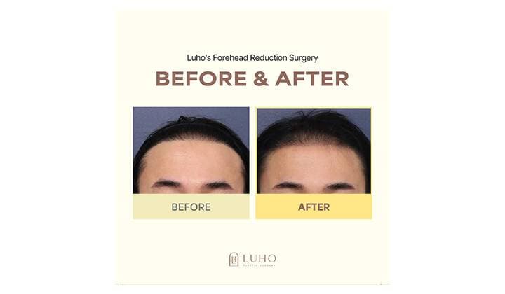 Forehead Reduction Surgery: A Real Before & After Review