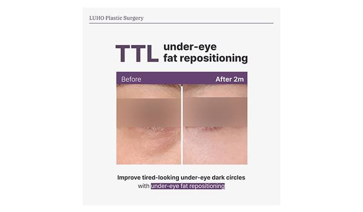How Under-Eye Fat Repositioning in Gangnam Transformed a Tired-Looking Expression