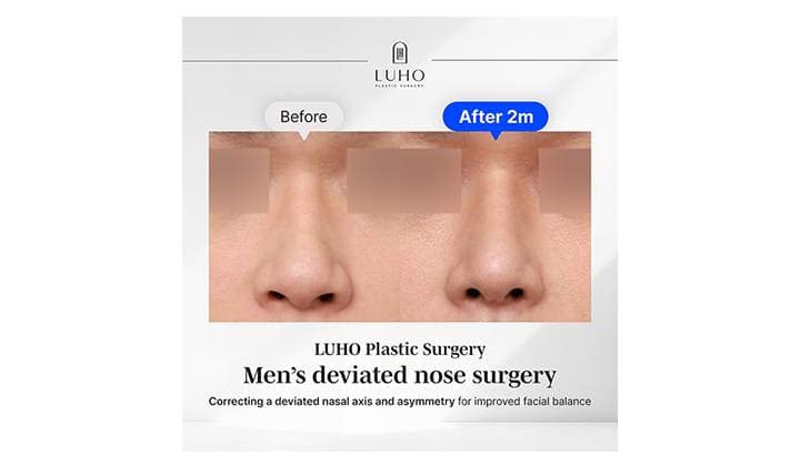 Men’s Rhinoplasty in Gangnam and Sinsa: A Tailored Approach to a More Balanced Look