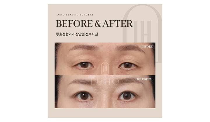 신사역 상안검수술로 눈꺼풀 처짐 개선한 후기