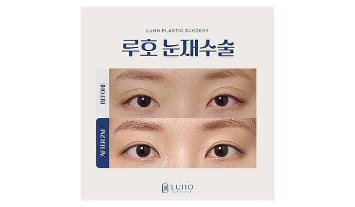 들린 속눈썹, 신사역 눈재수술로 해결한 사례 공개