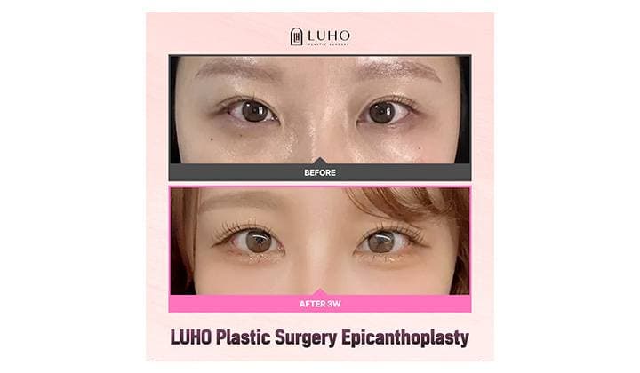 Tracking the Recovery Stages of Epicanthoplasty