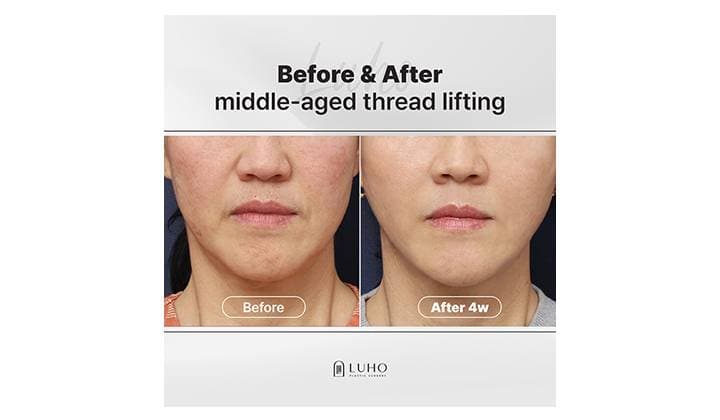 A Case of Reducing Lower Face Heaviness with Thread Lifting in Middle Age at Sinsa