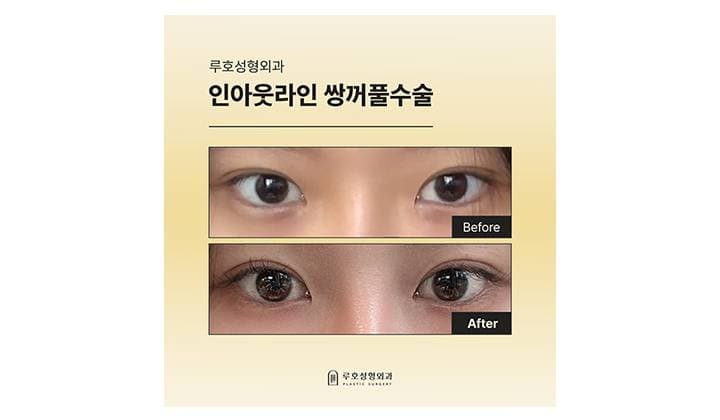 쌍꺼풀 수술 전후로 달라진 눈매, 후기로 살펴보기