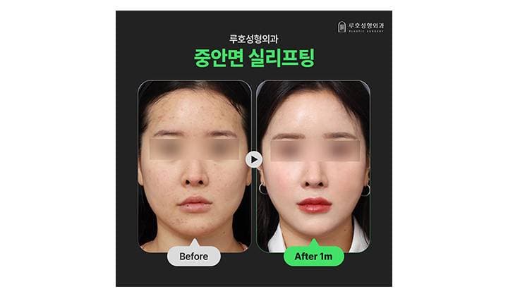 강남 신사역 중안면부 실리프팅이 바꿔준 이미지 살펴보기