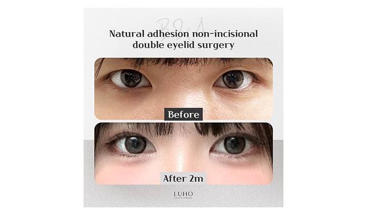 Clearer, More Defined Eyes After Double Eyelid Surgery in Sinsa
