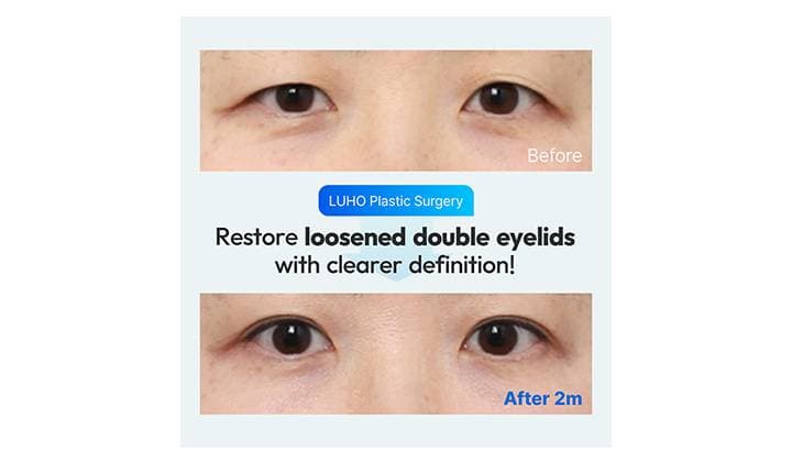 Revision Eyelid Surgery in Gangnam, Sinsa: Restoring Clearer Double Eyelids