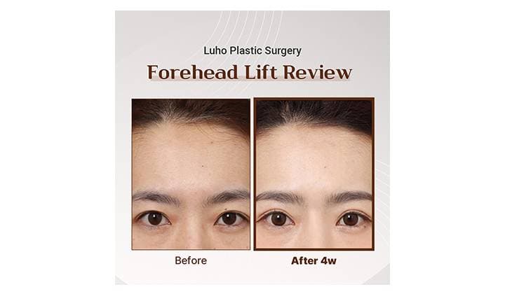 Achieve a naturally youthful look with Sinsa forehead lifting