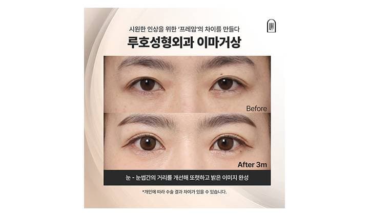밝고 시원한 인상을 만든 강남 신사역 이마거상 후기
