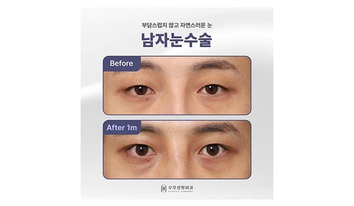 강남 신사역 남자눈수술, 답답한 눈매 교정한 후기