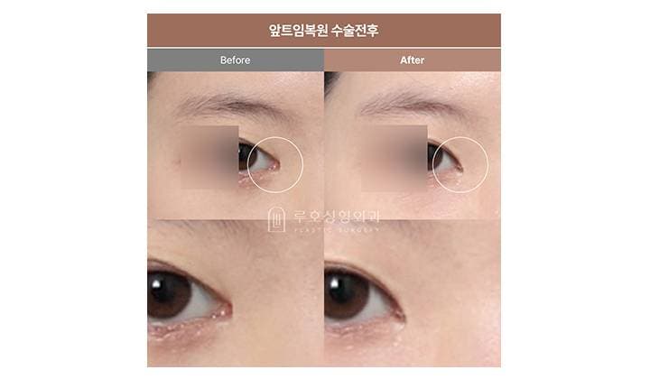 앞트임 복원 필요한 시기는?