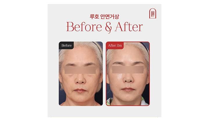 마리오네트 주름 완화한 신사역 안면거상술 후기
