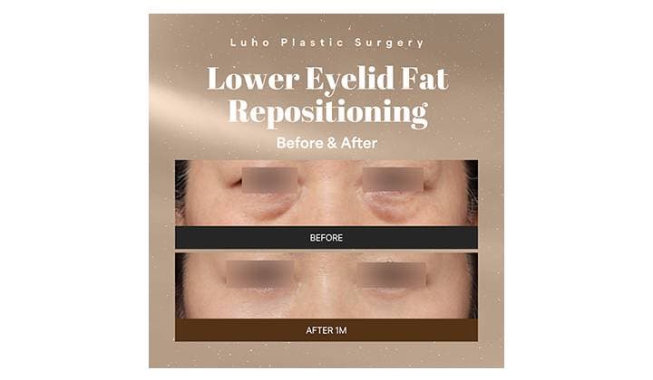 LUHO Plastic Surgery: Discover a Brighter Look with Lower Eyelid Fat Repositioning