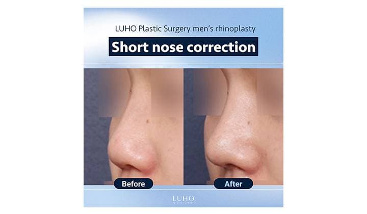 Sinsa short nose surgery for men — real case review