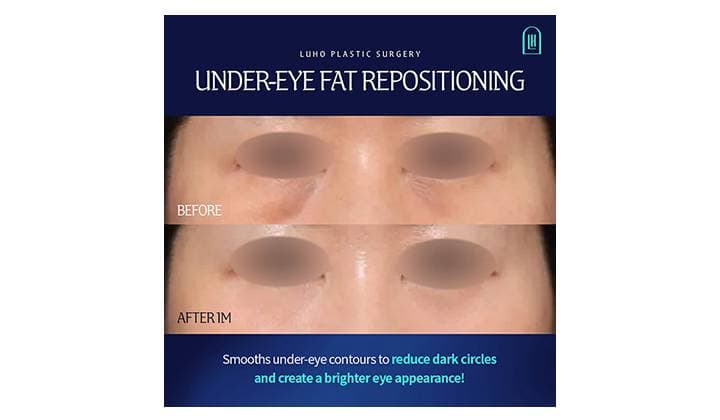 Under-Eye Fat Repositioning for Structural Dark Circles in Gangnam Sinsa