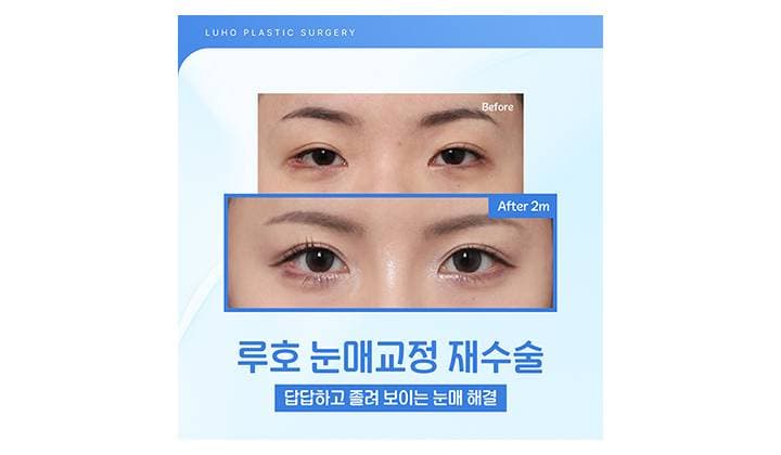 안검하수를 개선한 신사역 눈매교정 재수술 후기