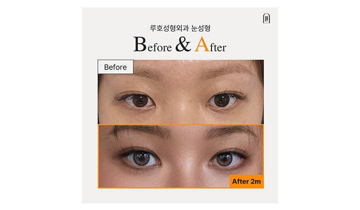 눈매, 눈꼬리까지 달라진 신사역 눈성형 효과