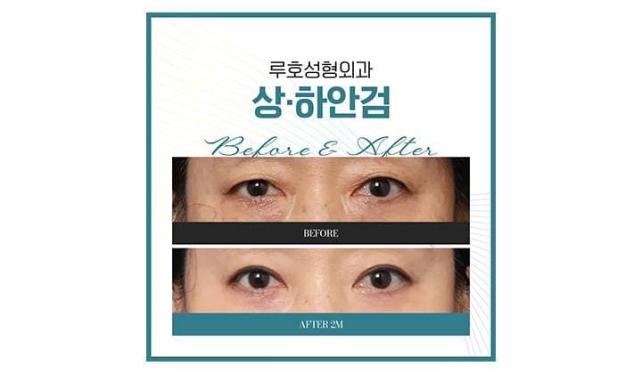 무거워 보이던 눈매 달라진 신사역 중년눈성형 후기