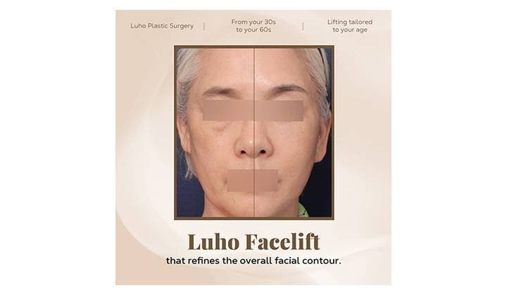 Facelift review in Sinsa restoring overall facial balance