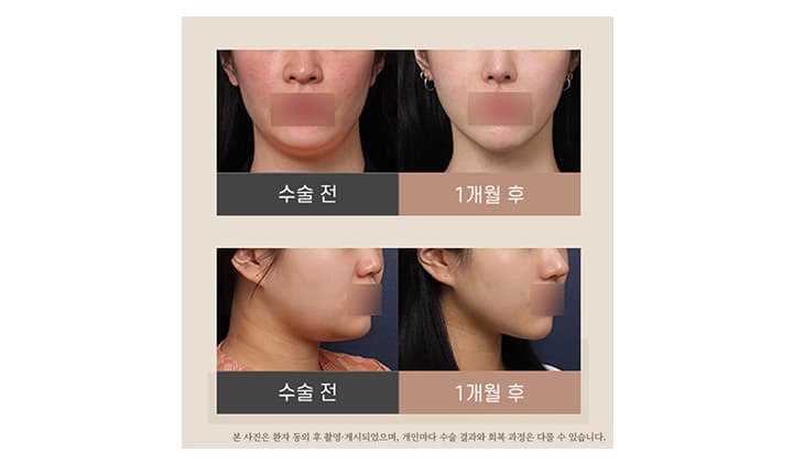 미니거상 전후 비교 후기