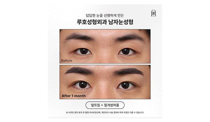 답답한 눈을 또렷하게 바꾼 강남 신사역 남자눈성형 전후