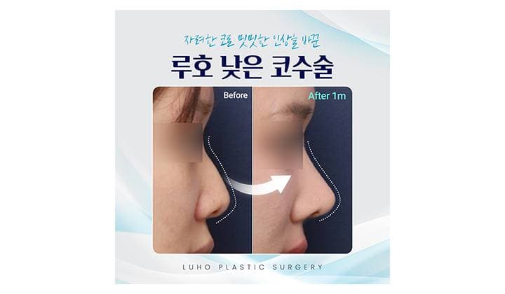 밋밋한 인상을 자려한 코로 바꾼 신사역 낮은코수술 후기