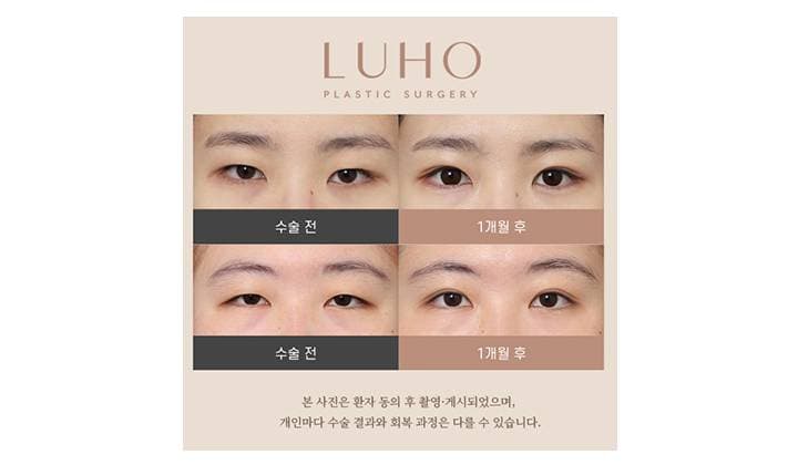졸린 눈 눈매교정 전후 살펴보기
