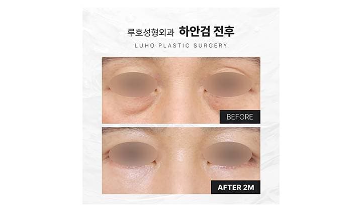 무거운 눈밑 바꿔준 강남 신사역 하안검 수술